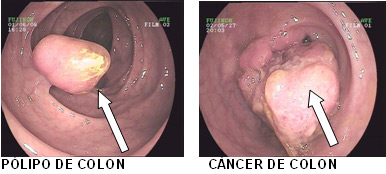Pólipo de colon y cáncer de colon