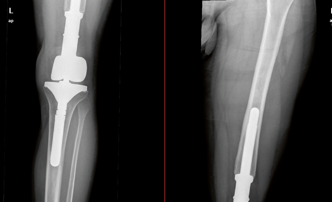 Cirugía conservadora de extremidad: resección completa de un sarcoma de Ewing en diáfisis femoral, sustitución con injerto óseo alogénico y estabilización con clavo.